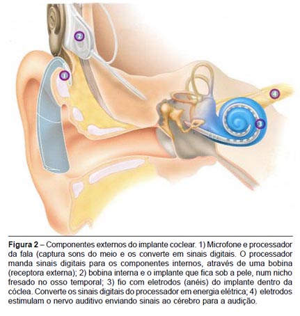 análogo de los implantes cocleares