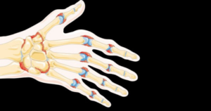 Read more about the article (Português do Brasil) Descoberto mecanismo inflamatório responsável pela erosão óssea na artrite reumatoide